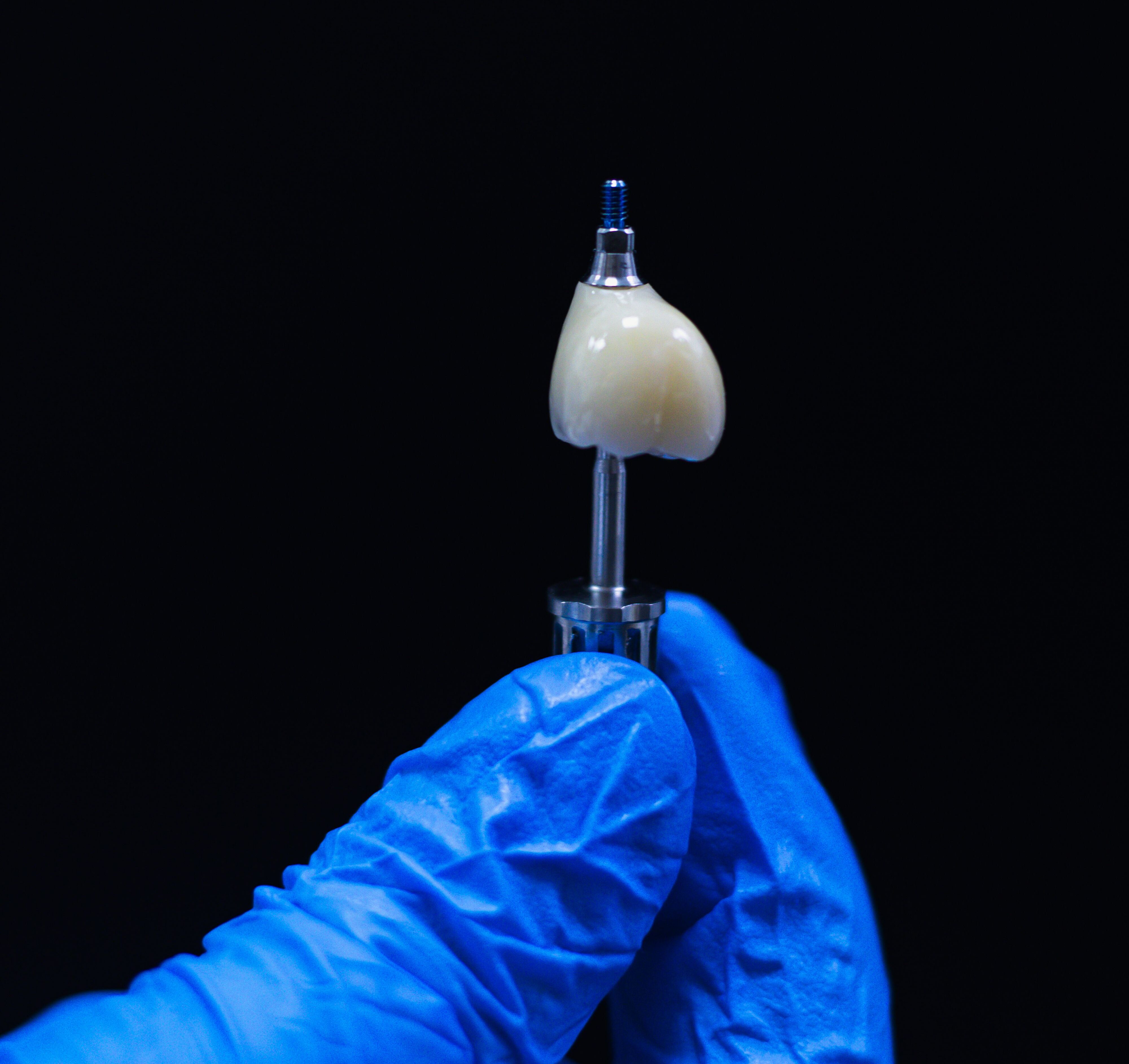 Dental implant placement for single tooth replacement, showing the implant and crown
