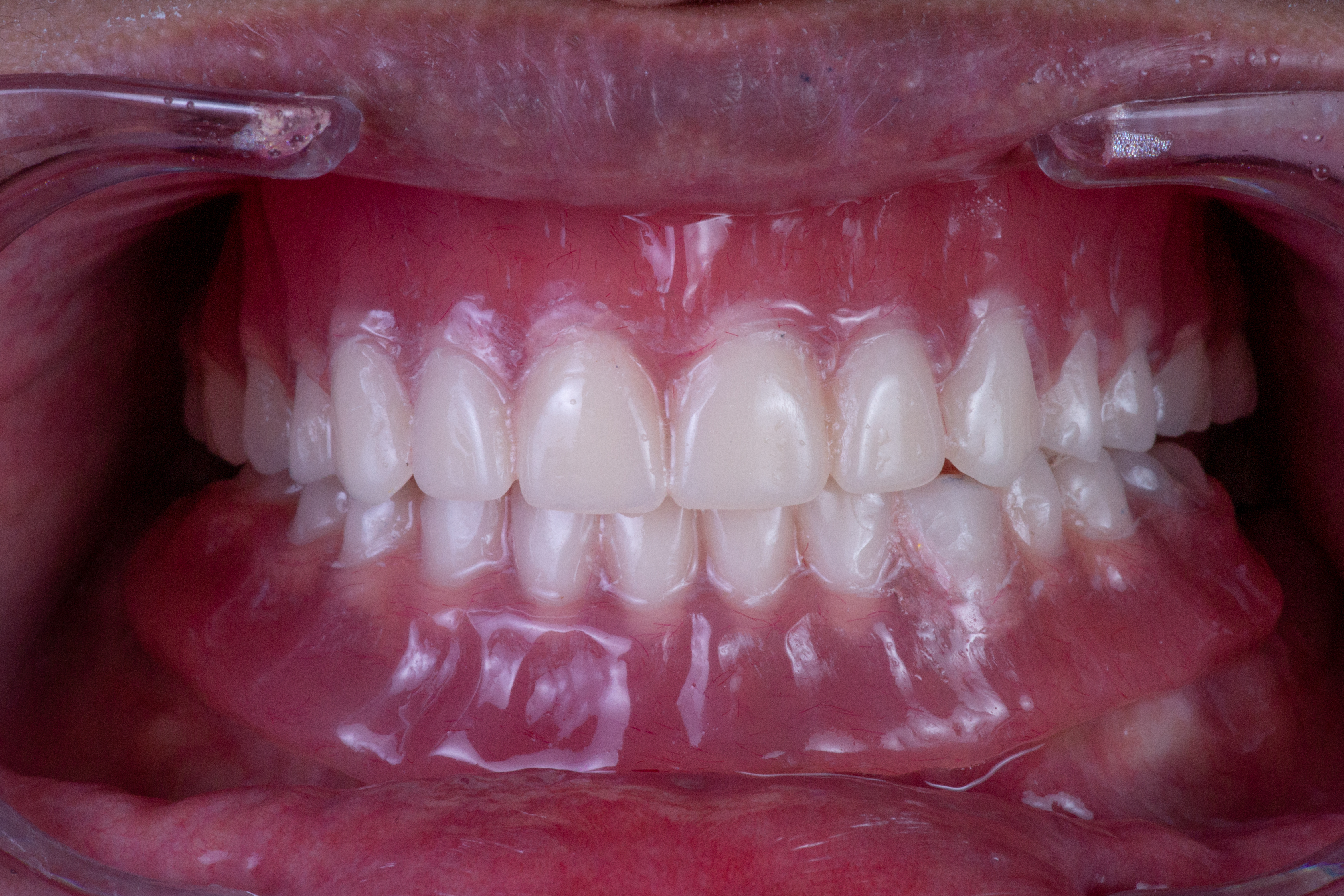 Mandibular immediate rehabilitation with dental implants to restore oral function and a natural-looking smile.