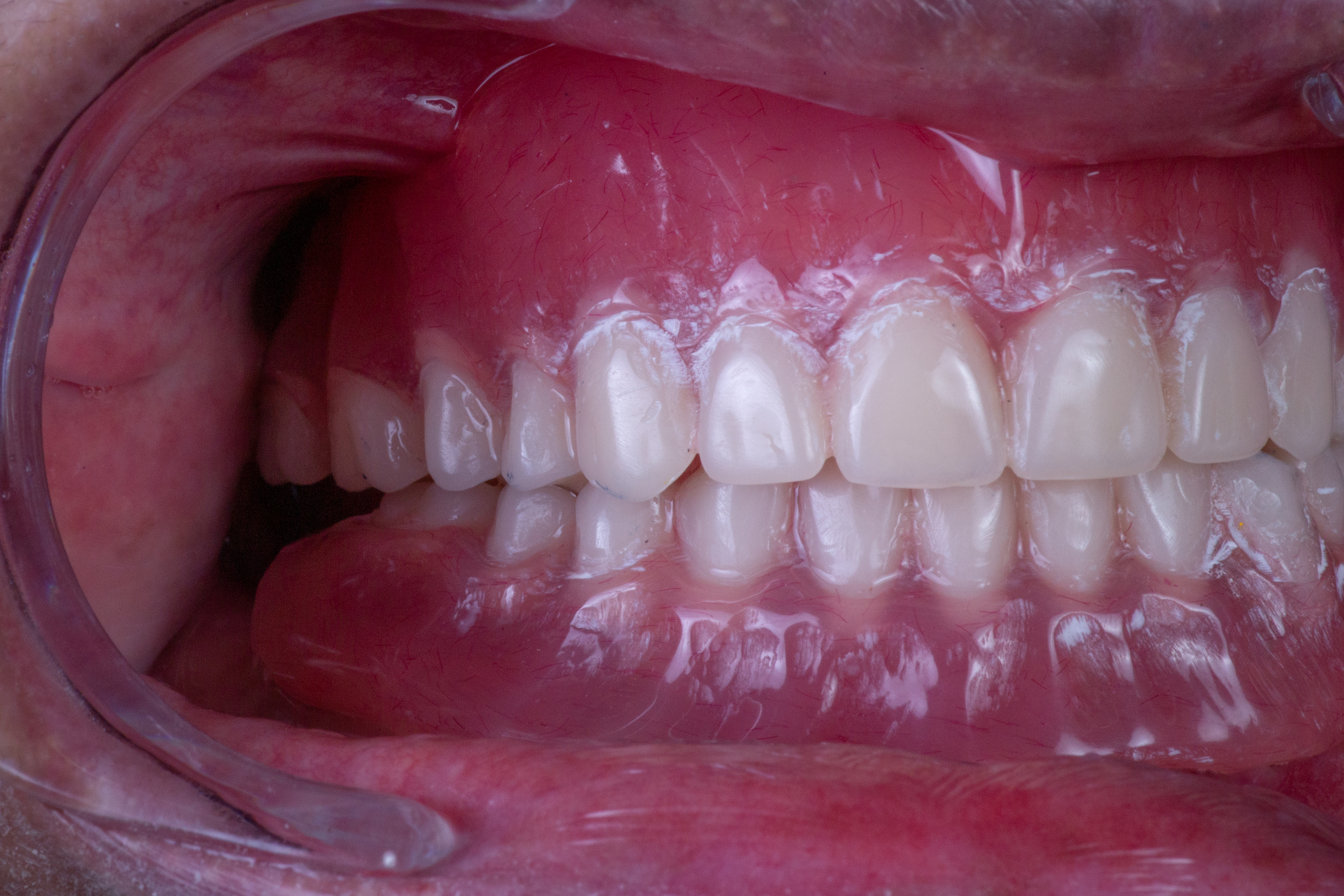 Surgical extraction and site preparation for dental implant placement and full-mouth rehabilitation.