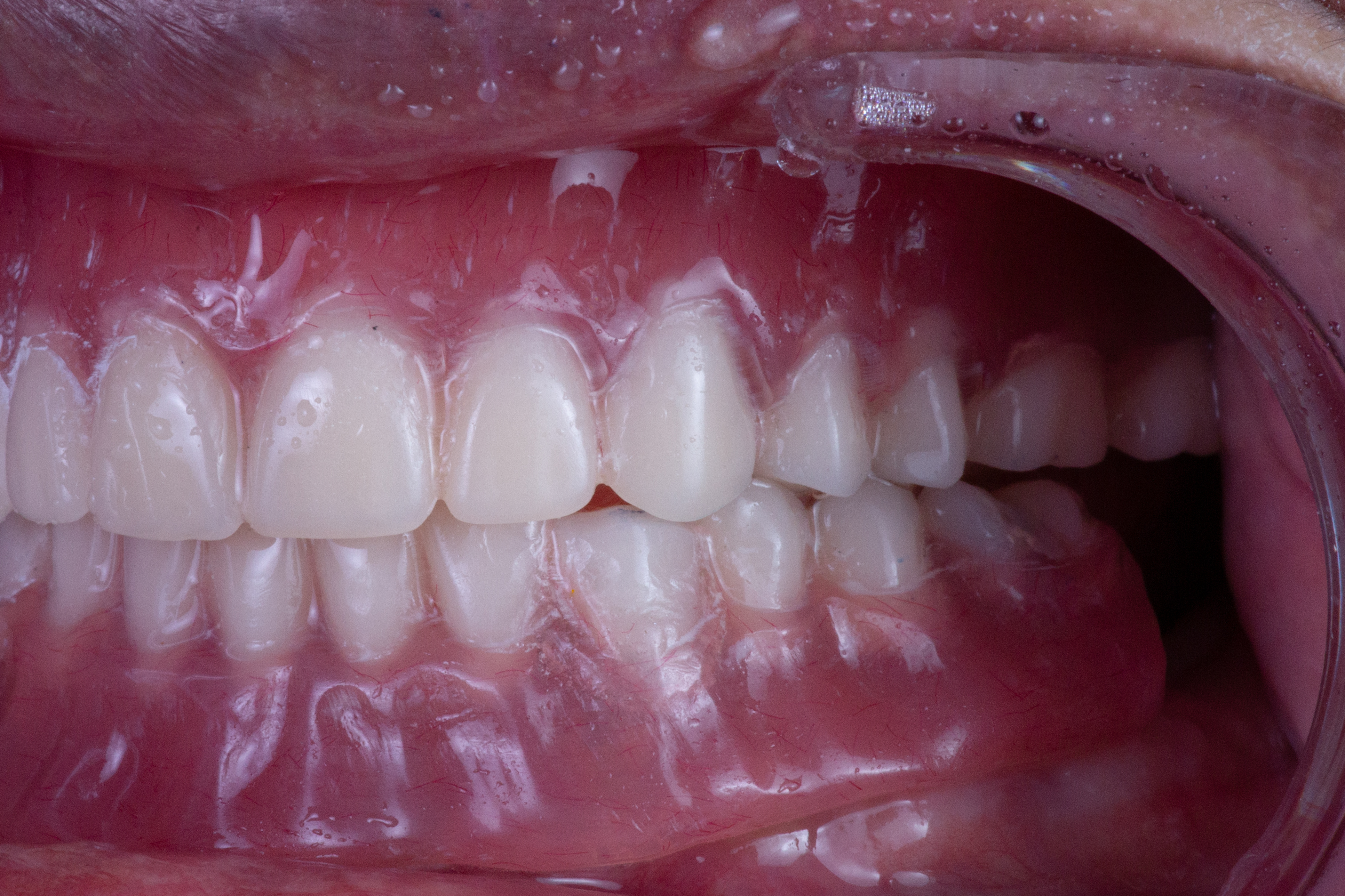 Maxillary phased therapy as part of a comprehensive dental rehabilitation plan to restore oral health and function.