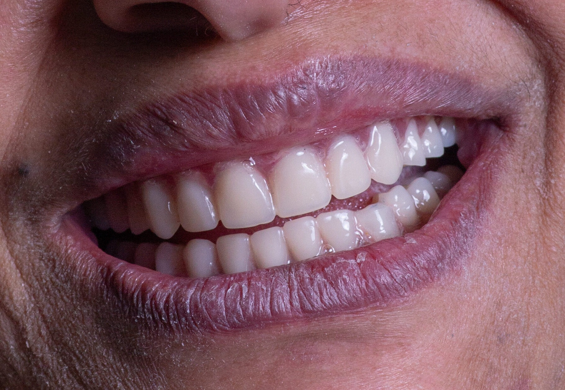 Full mouth dental implant rehabilitation to restore missing teeth, oral function, and a natural-looking smile.